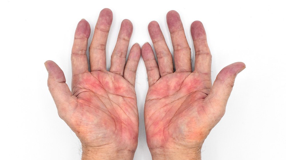 What Causes Palmar Erythema And What Does It Mean For Your Health