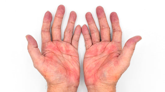 What Causes Palmar Erythema And What Does It Mean For Your Health