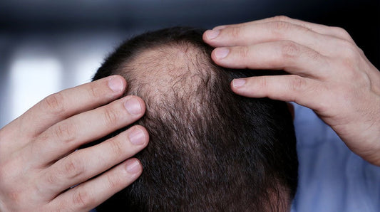 Male Pattern Baldness: Causes, Symptoms & Treatment